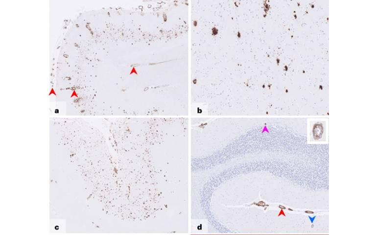 amyloid_deposits.jpg