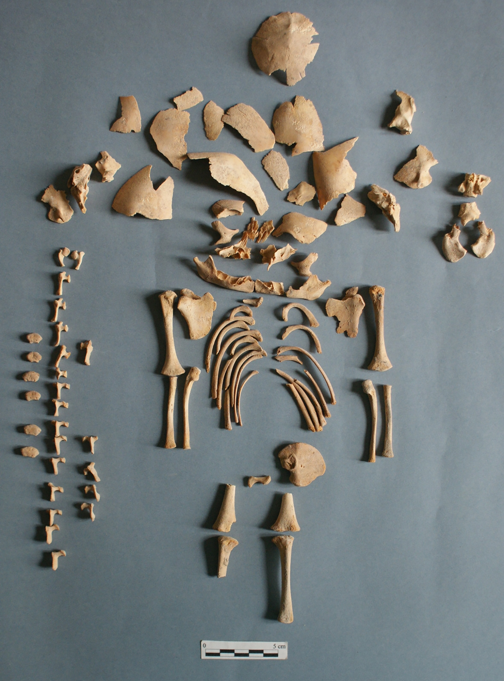 Remains-of-Individual-CRU001-Who-Had-Down-Syndrome.jpg